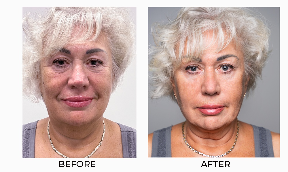 Before After anti aging result real customer